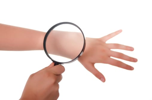 Ernst huid- en haarziekten van 1 miljoen Nederlanders sterk onderschat Door Redactie Medicalfacts/ Janine Budding - 18 november 20170647 Deel op Facebook Tweet op Twitter hand, magnifying glass and skin Barrières en schaamte bij patiënten doorbreken Huid- en haarziekten verpesten het leven van ruim 1 miljoen Nederlanders en drijft hen soms tot wanhoop. Het is belangrijk om patiënten een hart onder de riem te steken, maar ook om de schaamte te doorbreken. Huidziekten zijn vaak ingrijpend. Naast fysieke uitingen en lichamelijk ongemak, hebben patiënten vaak ook psychische klachten. Met ‘Happy met je huid’ wil HPN het zelfbewustzijn van huidpatiënten in Nederland vergroten en tegelijkertijd aandacht vragen voor de ernst en impact van huidziekten. Onderschat probleem In Nederland heeft 1 op de 15 mensen een chronische huid- of haarziekte. De impact op hun leven is bijzonder groot. Naast lichamelijke gevolgen die patiënten ervaren – zoals jeuk en pijnlijke plekken – zijn er ook psychosociale gevolgen door schaamte, pesten, en problemen op de arbeidsmarkt. Het dagelijks functioneren wordt vaak ernstig verstoord. Chris Westerlaken, voorzitter van HPN en zelf huidpatiënt: “De schaamte wordt vaak versterkt vanwege het feit dat de omgeving vaak afwijzend en negatief reageert op mensen met een zichtbare huidziekte, bijvoorbeeld op het strand, op het terras of op straat. We willen door het creëren van meer bewustzijn onder de bevolking meer erkenning voor mensen met een huidziekte.” HPN wil daarmee ook barrières voor patiënten doorbreken, zoals seksualiteit en schaamte. Daarom staat het festival in het teken van verbinding: het ontmoeten van lotgenoten, patiëntenorganisaties en zorgverleners. Westerlaken: “Zo willen we huidpatiënten en hun naasten informeren over manieren om de kwaliteit van leven te verbeteren en hopen we ook dat betrokkenen elkaar kunnen stimuleren en inspireren.” Voeding, schaamte en seksualiteit Tijdens het festival staat ‘Positieve Gezondheid’ centraal: gezondheid dient niet te worden gezien als de af- of aanwezigheid van ziekte, maar als het vermogen van mensen om met de fysieke, emotionele en sociale levensuitdagingen om te gaan. De dag wordt verder aan de hand van drie thema’s ingevuld: Huid & Voeding, Huid & Schaamte en Huid & Seksualiteit. Deze thema’s zijn erg bepalend voor de kwaliteit van leven van patiënten. Onder andere workshops flirten, lezingen over huid en seksualiteit, het Lotgenotencafé en een professionele photoshoot worden gehouden op het festival. De workshops helpen patiënten en hun naasten om met chronische huidaandoeningen om te gaan. Huidhelden Tijdens het festival, georganiseerd in samenwerking met de Nederlandse Vereniging voor Dermatologie en Venereologie, de Nederlandse Vereniging van Huidtherapeuten en het Huidfonds, wordt de campagne ‘Huidhelden in beeld’ gelanceerd. De publiekscampagne ‘Huidhelden’ van het Huidfonds richt zich op acceptatie van de huid en bevat verhalen van inspirerende mensen die leven met een huid die ‘anders’ is. Één van hen is Chris Westerlaken: “Het belangrijkste streven is een samenleving waarin mensen – ongeacht hun huid – zelfverzekerd en positief zijn, over zichzelf en elkaar”.