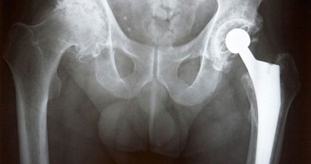 knie versleten